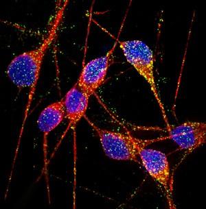 Neurônios afetados pela doença de Alzheimer apresentam diferenças sutis com os saudáveis, mas suficientes para causar uma doença que afeta a capacidade de memória e aprendizado. (Foto: Faculdade de Medicina de San Diego / Universidade da Califórnia / Nature / Divulgação)
